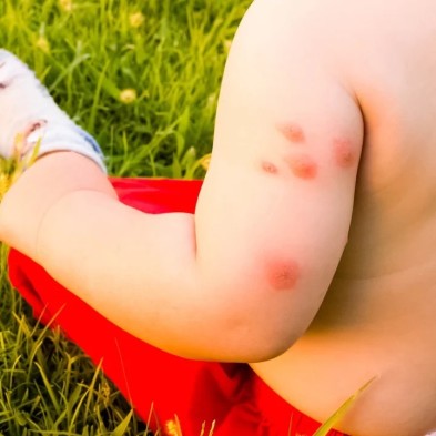Picaduras de mosquitos: cómo prevenirlas y aliviar el picor este verano